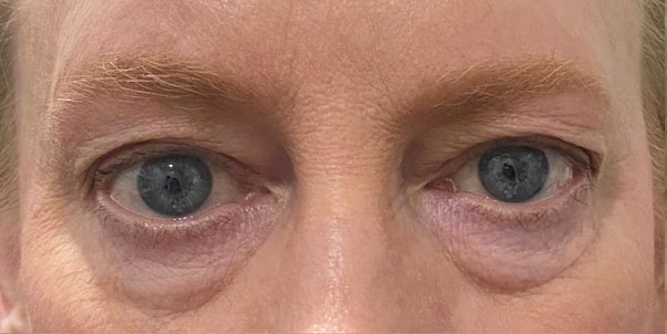 Lower Eyelid Blepharoplasty Plano Tx Legacy Eyelids Cosmetic Surgery