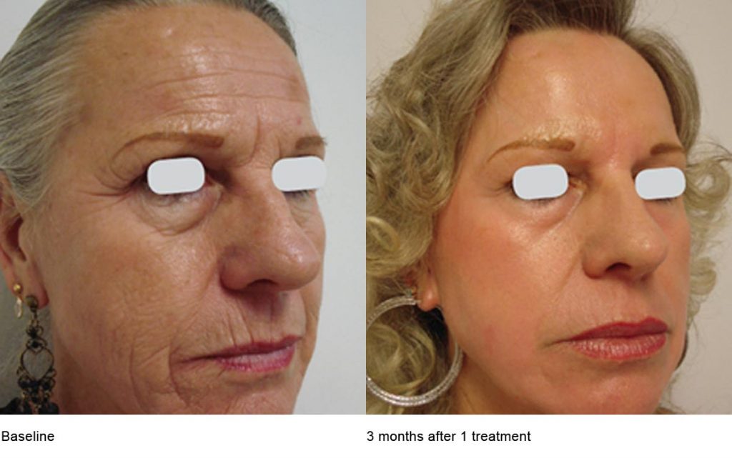 CO2 Laser Skin Resurfacing Patient-1