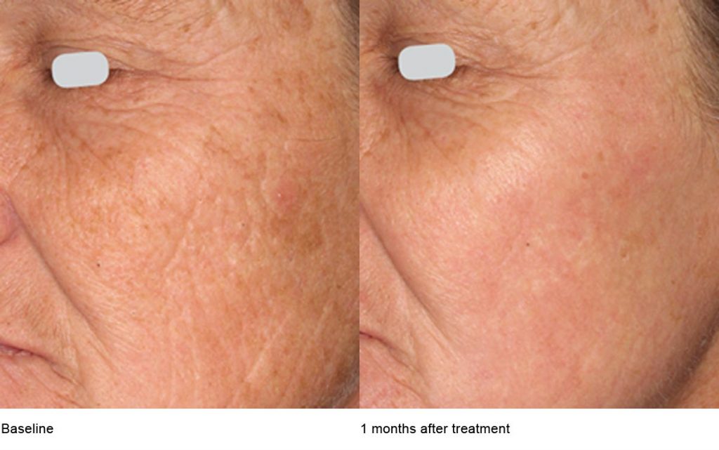 CO2 Laser Skin Resurfacing Patient-2