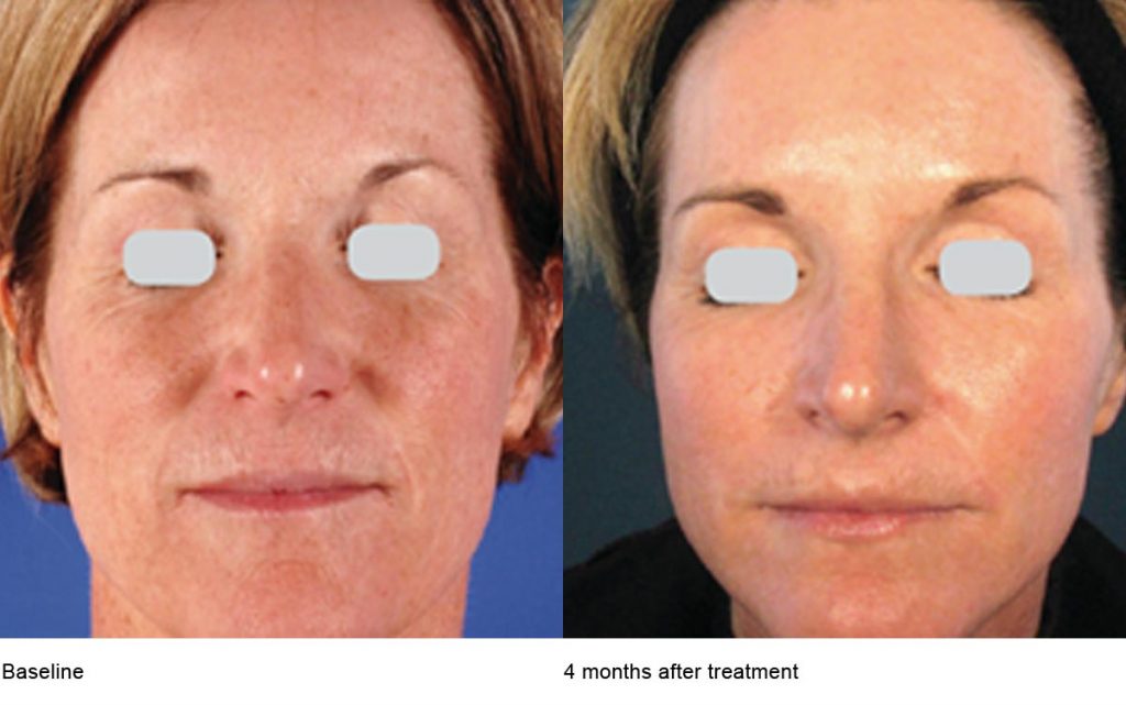 CO2 Laser Skin Resurfacing Patient-3