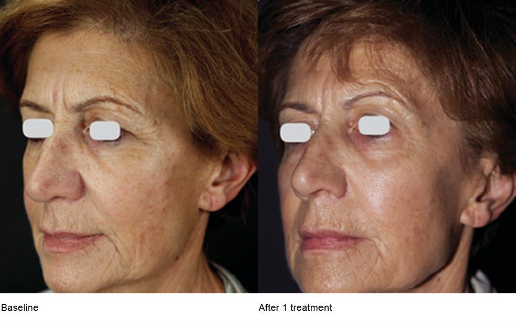 CO2 Laser Skin Resurfacing Patient-4