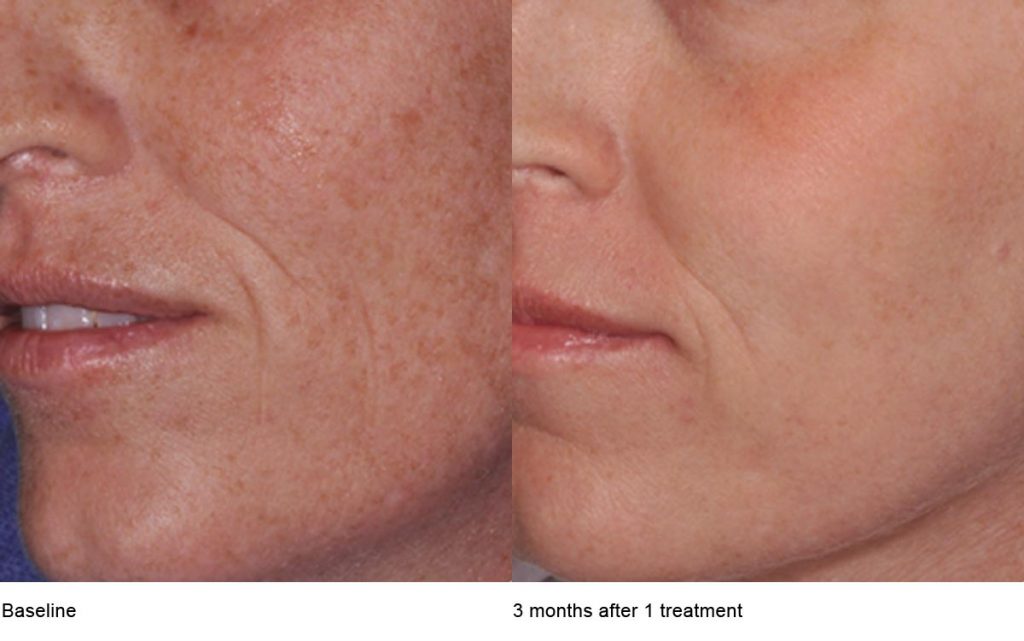 CO2 Laser Skin Resurfacing Patient-5