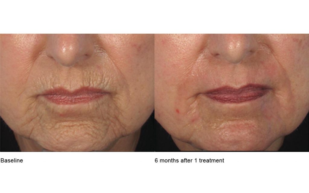 CO2 Laser Skin Resurfacing Patient-6