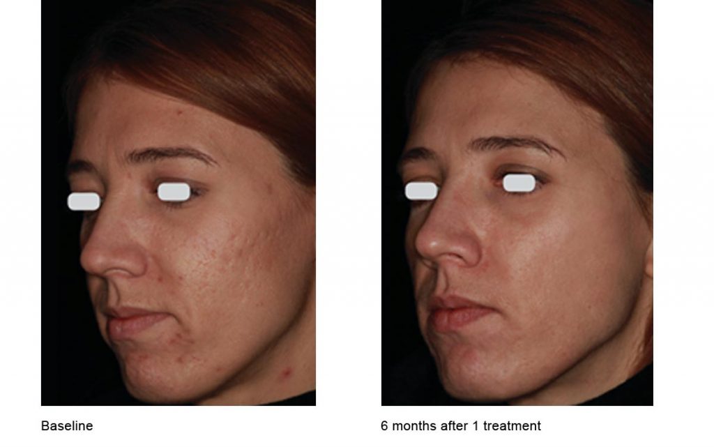 CO2 Laser Skin Resurfacing Patient-7