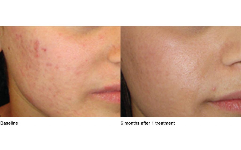 CO2 Laser Skin Resurfacing Patient-8