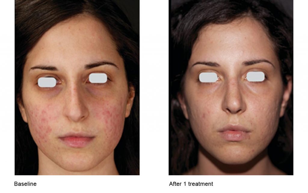 CO2 Laser Skin Resurfacing Patient-9