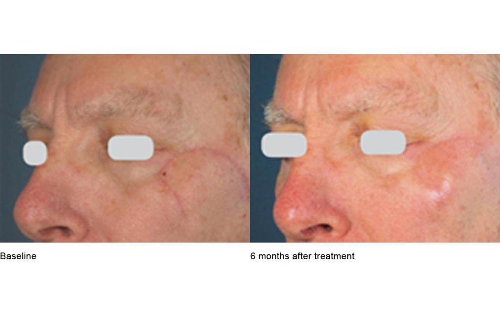 CO2 Laser Skin Resurfacing Patient-10