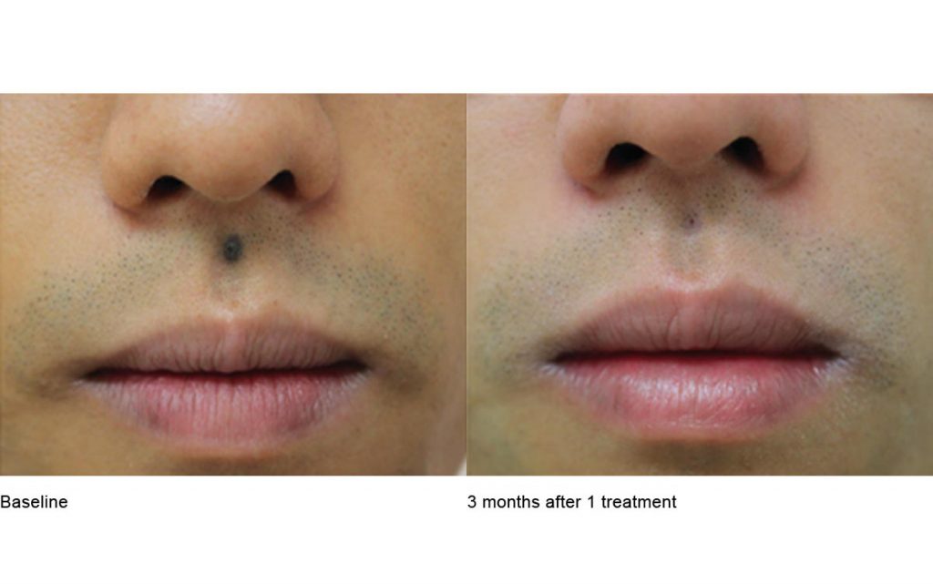 CO2 Laser Skin Resurfacing Patient-11