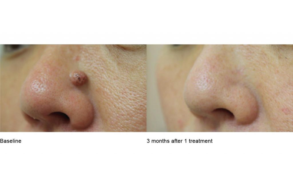 CO2 Laser Skin Resurfacing Patient-12