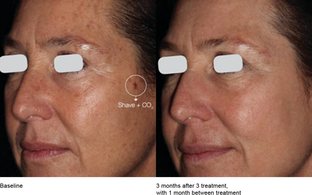 CO2 Laser Skin Resurfacing Patient-13