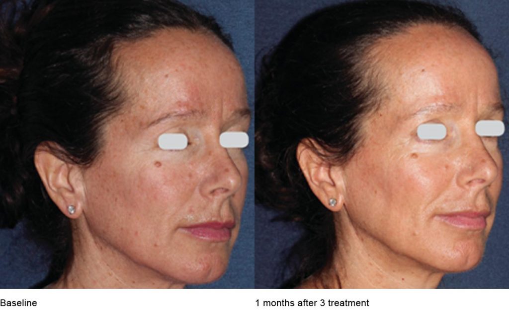 CO2 Laser Skin Resurfacing Patient-14