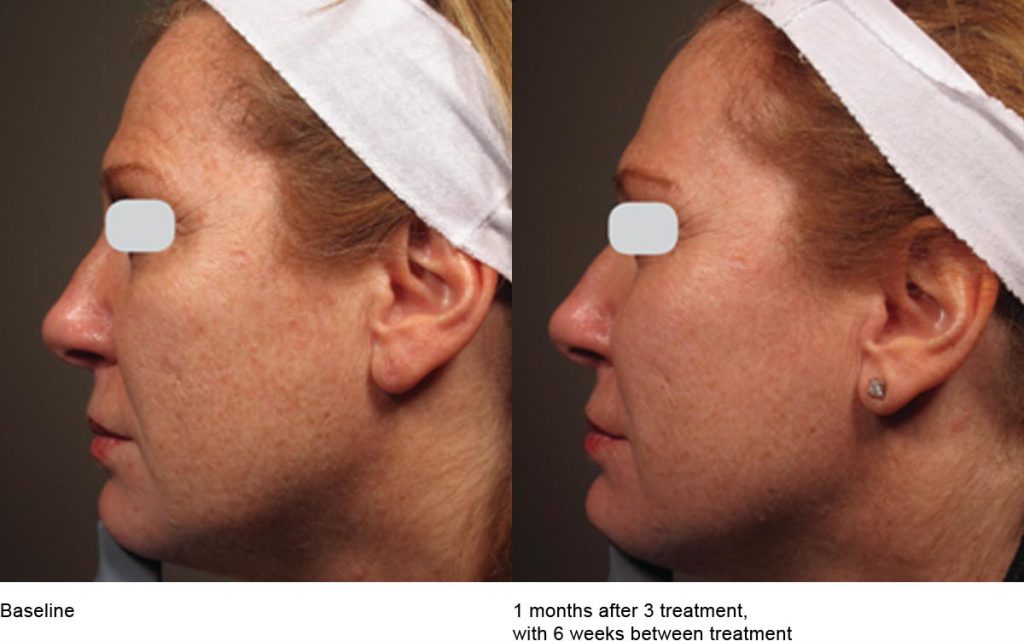 CO2 Laser Skin Resurfacing Patient-15