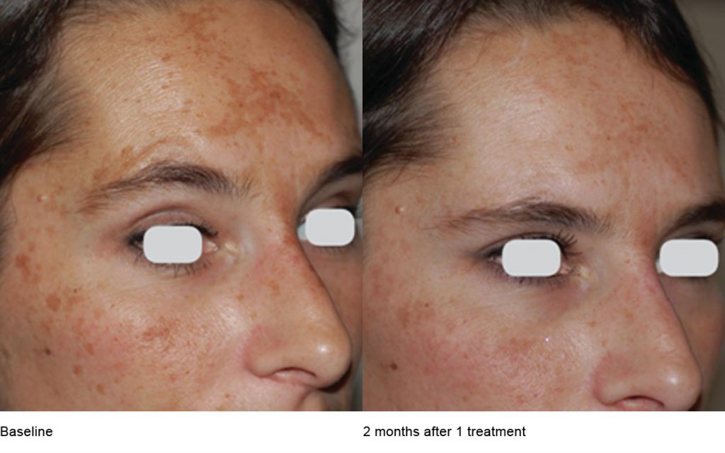 CO2 Laser Skin Resurfacing Patient-16