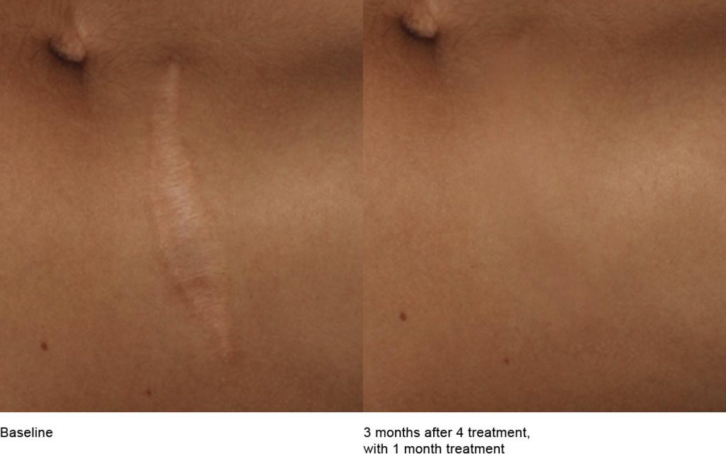 CO2 Laser Skin Resurfacing Patient-17