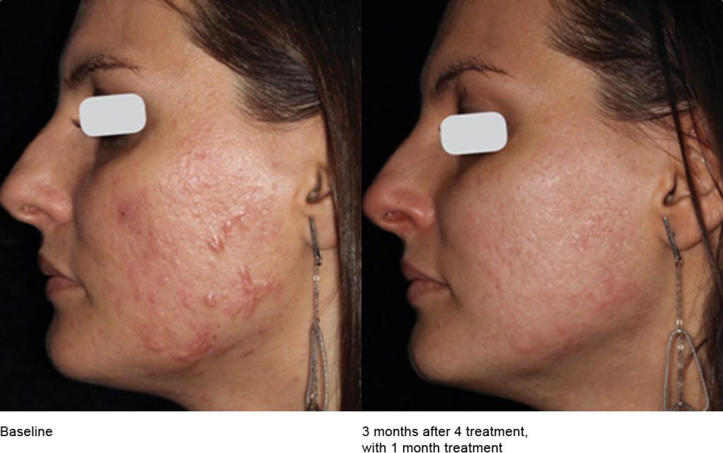 CO2 Laser Skin Resurfacing Patient-18