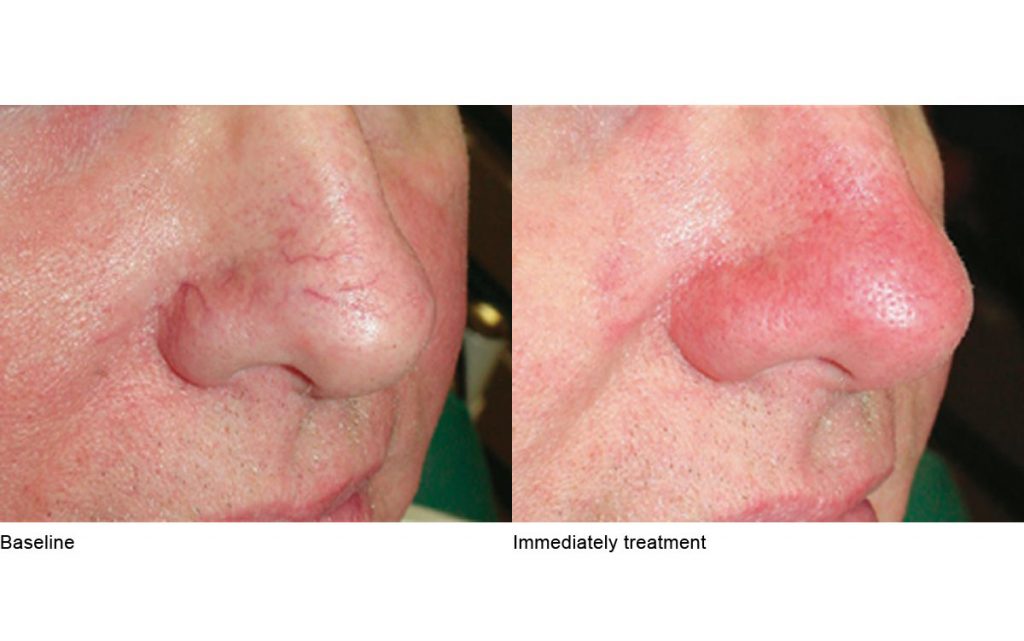 CO2 Laser Skin Resurfacing Patient-19