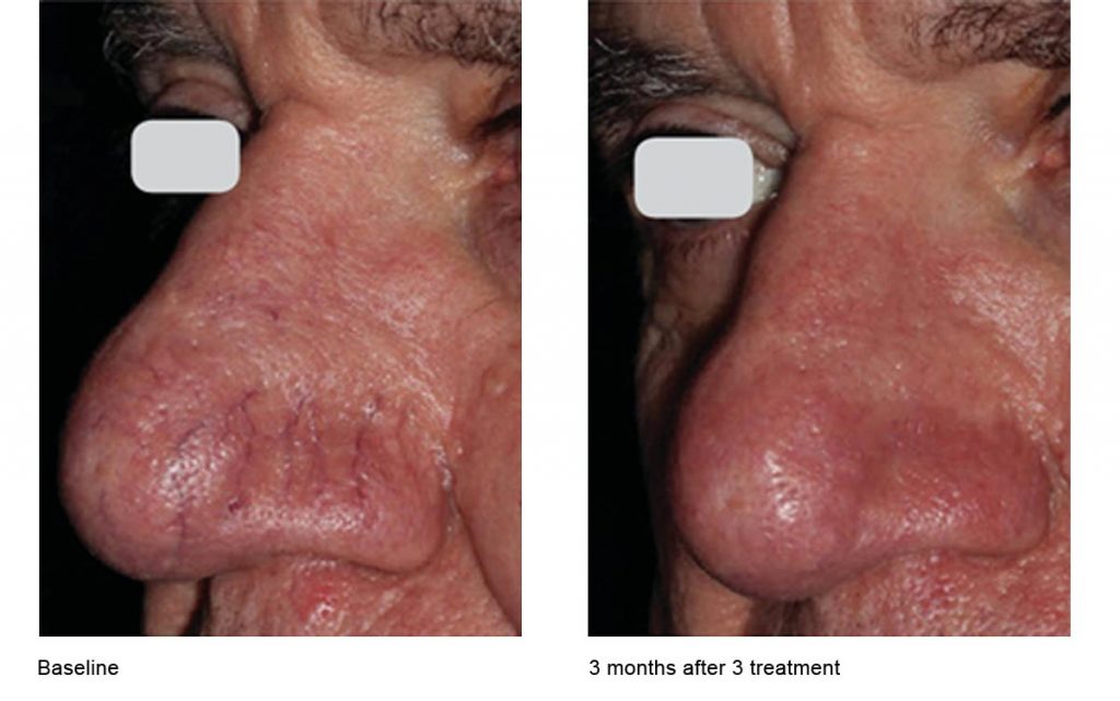 CO2 Laser Skin Resurfacing Patient-20