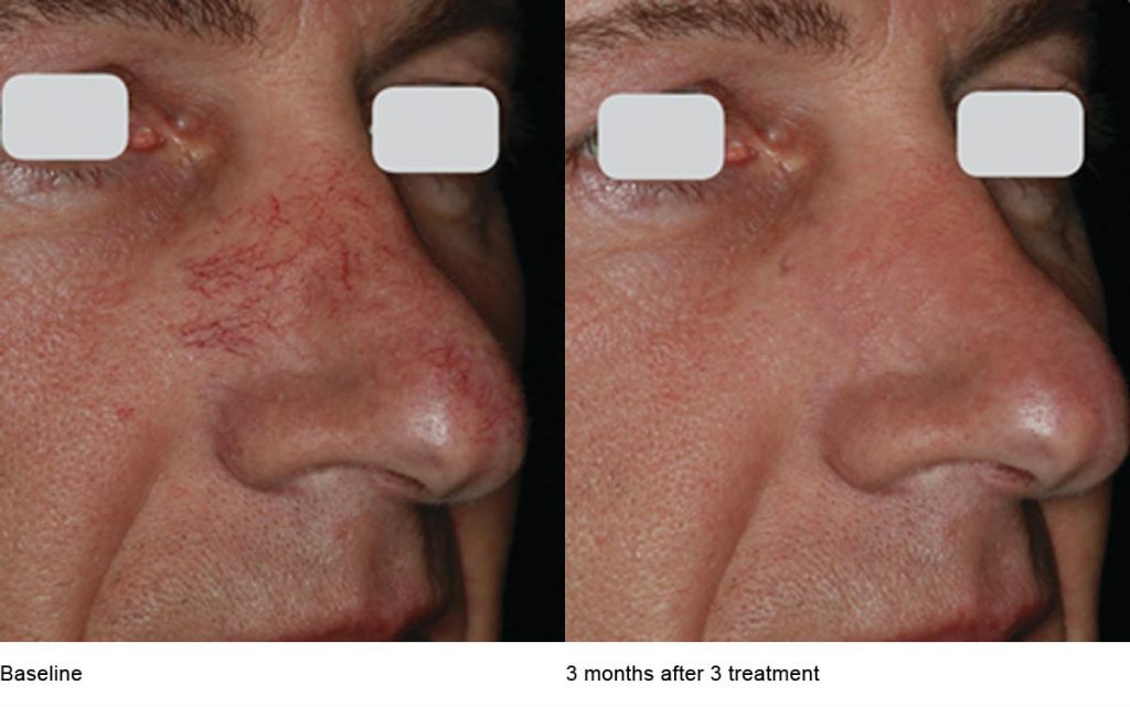 CO2 Laser Skin Resurfacing Patient-21