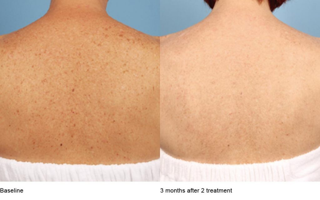 CO2 Laser Skin Resurfacing Patient-22