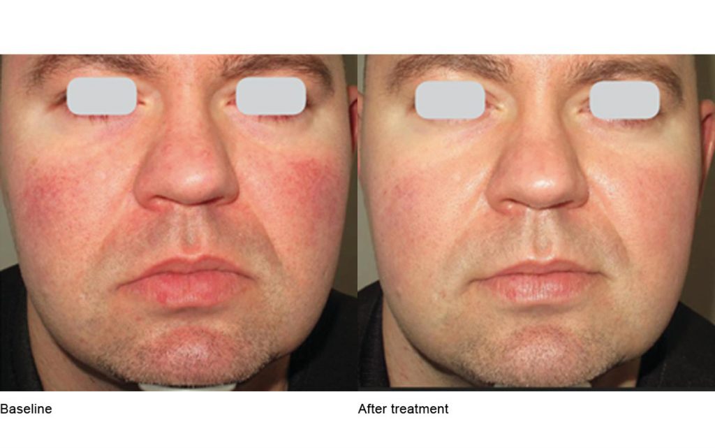 CO2 Laser Skin Resurfacing Patient-23