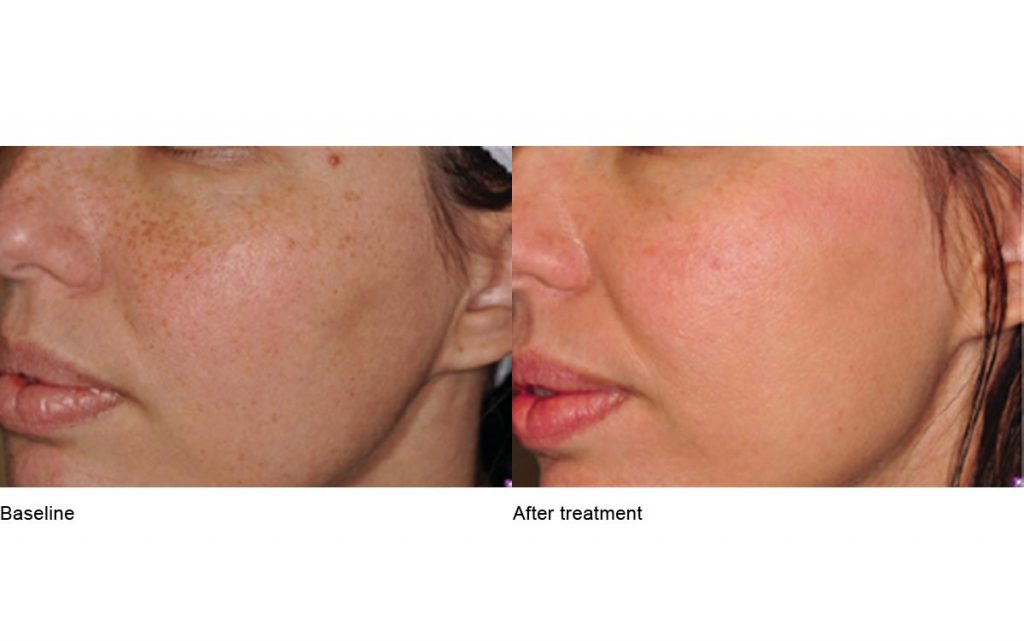 CO2 Laser Skin Resurfacing Patient-25