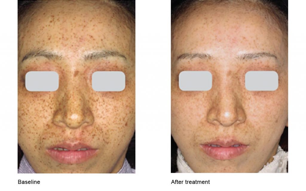 CO2 Laser Skin Resurfacing Patient-26