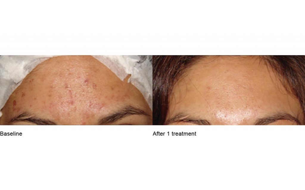 CO2 Laser Skin Resurfacing Patient-28