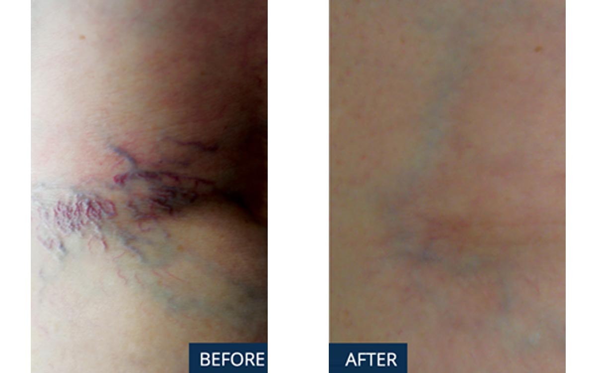 Premier Tattoo removal Offers Tattoo Removal Services in Dallas, TX