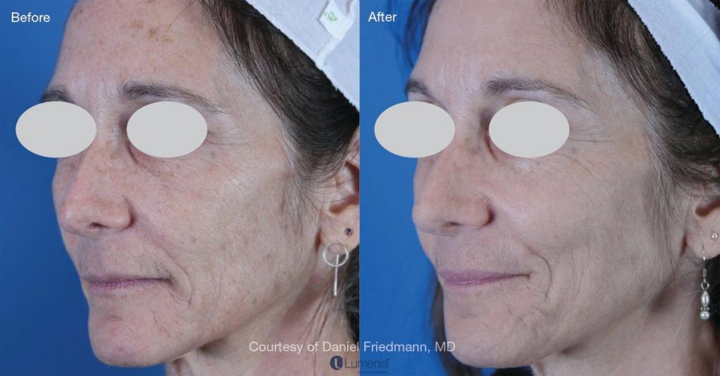 Photorejuvenation Patient-2