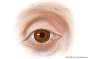 A stye is an infection image