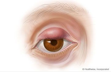 A chalazion is a lump in the eyelid image