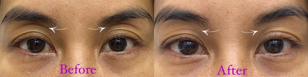 Upper Eyelid Filler Patient-1