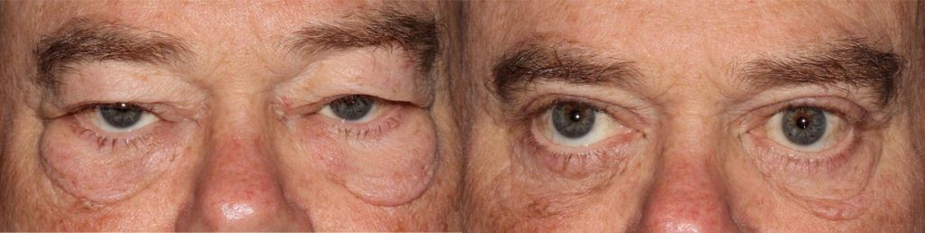 Cosmetic Lower Eyelid Blepharoplasty Patient 03