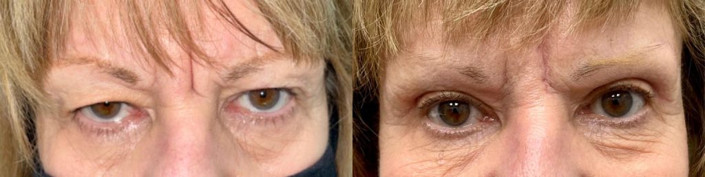 Cosmetic Upper Eyelid Blepharoplasty Patient 11