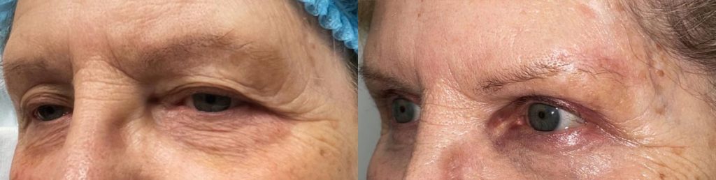 Cosmetic Brow Lift Patient 03