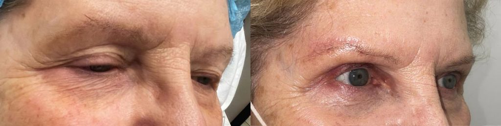 Cosmetic Brow Lift Patient 03