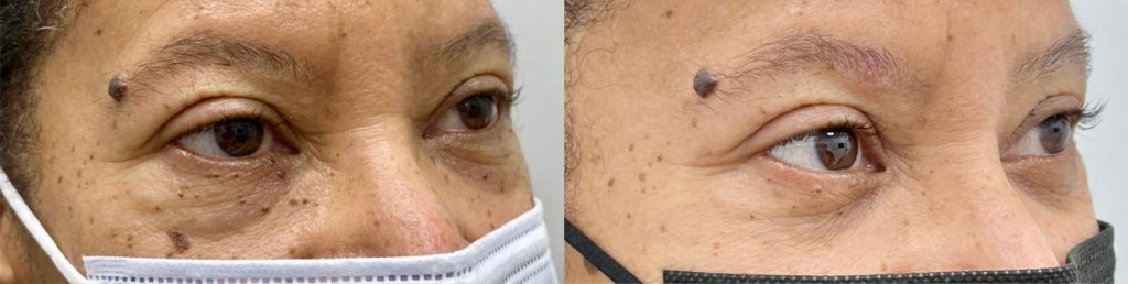 Cosmetic Lesion Removal Patient 01