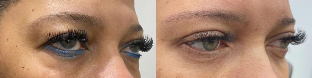 Cosmetic Lower Eyelid Blepharoplasty Patient 05