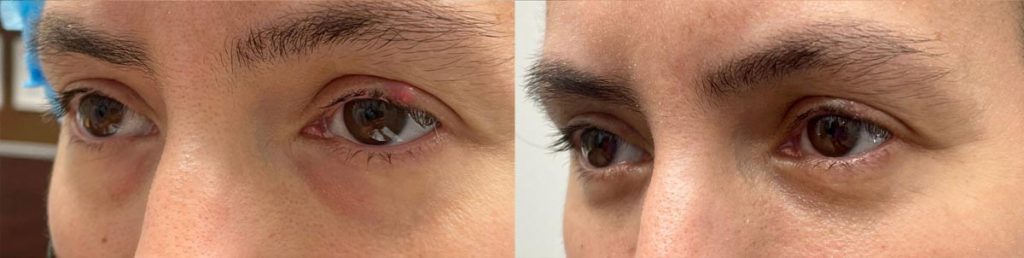 Cosmetic Lower Eyelid Blepharoplasty Patient 04