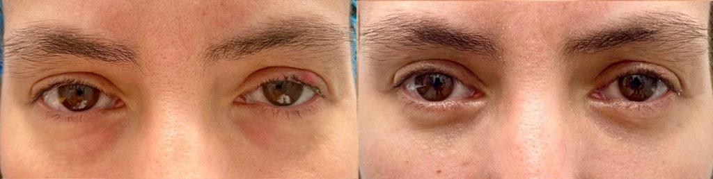 Cosmetic Lower Eyelid Blepharoplasty Patient 04