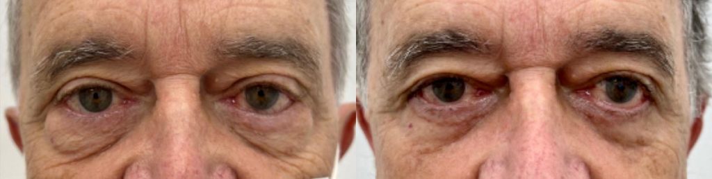 Cosmetic Lower Eyelid Blepharoplasty Patient 02