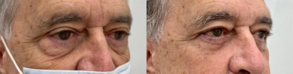 Cosmetic Lower Eyelid Blepharoplasty Patient 02