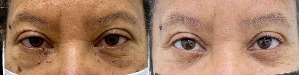 Cosmetic Lower Eyelid Blepharoplasty Patient 06