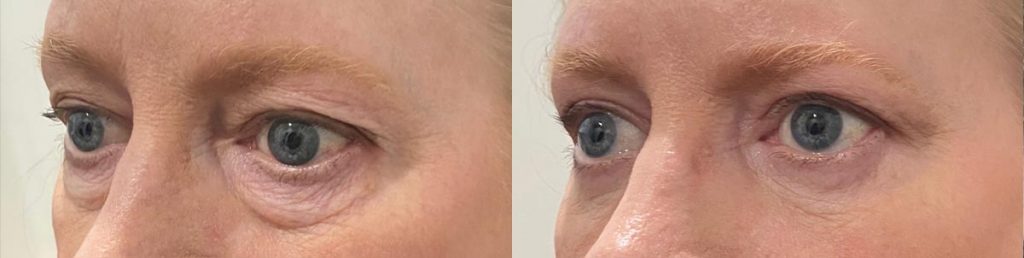 Cosmetic Lower Eyelid Blepharoplasty Patient 07