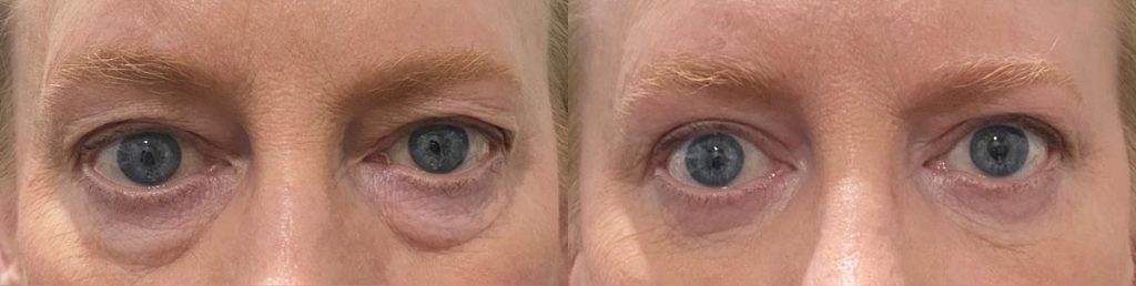Cosmetic Upper Eyelid Blepharoplasty Patient 04