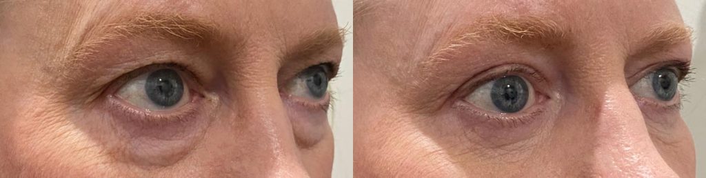 Cosmetic Lower Eyelid Blepharoplasty Patient 08