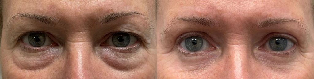 Cosmetic Lower Eyelid Blepharoplasty Patient 08