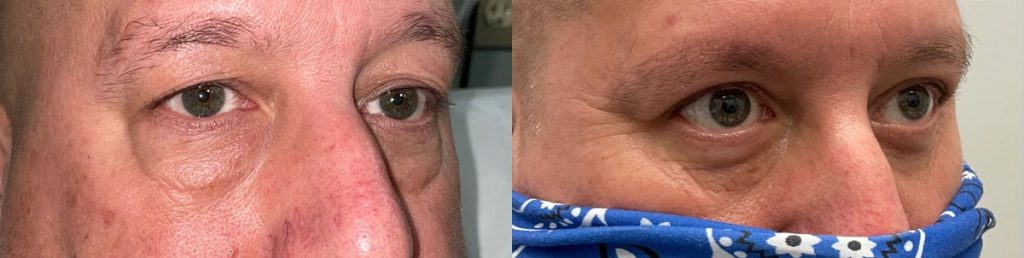 Cosmetic Lower Eyelid Blepharoplasty Patient 09