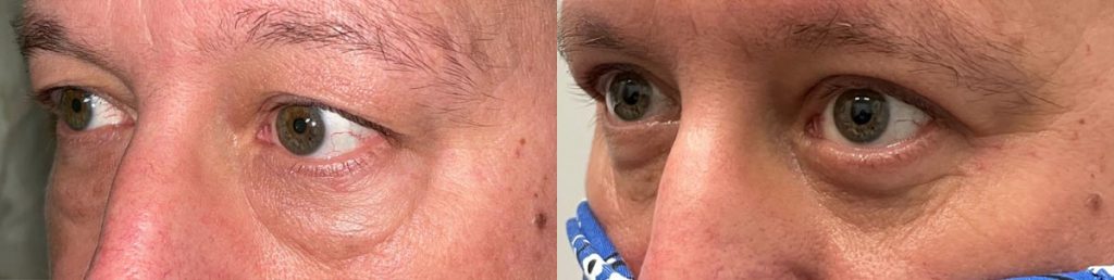 Cosmetic Lower Eyelid Blepharoplasty Patient 09
