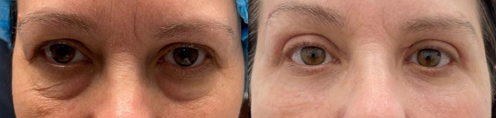 Cosmetic Lower Eyelid Blepharoplasty Patient 10